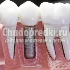 Разновидности зубных имплантов