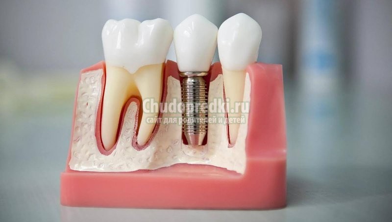 Технология All on 4 - уникальная методика, восстанавливающая зубы