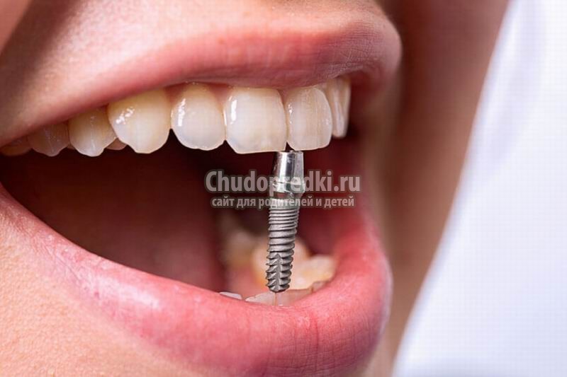 Технология All on 4 - уникальная методика, восстанавливающая зубы