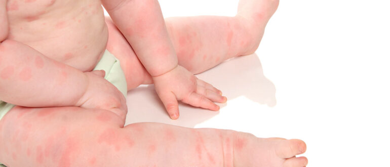 пищевая аллергия у малышей